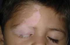The Causes of Vitiligo