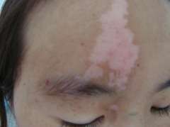 Several Reasons May Induce the Vitiligo