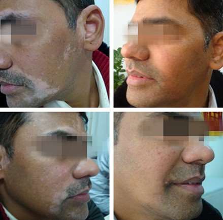 Indian Patient Recovered From Vitiligo In Beijing