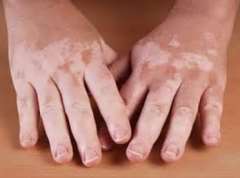 Why can kids get vitiligo