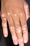 Acra Type Vitiligo Is Hard To Treat