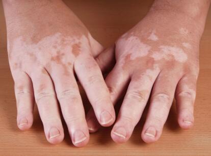 traditional Chinese medicine fumigation
