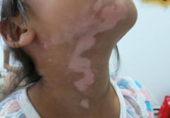 A Girl: Choose Professional Vitiligo Hospital