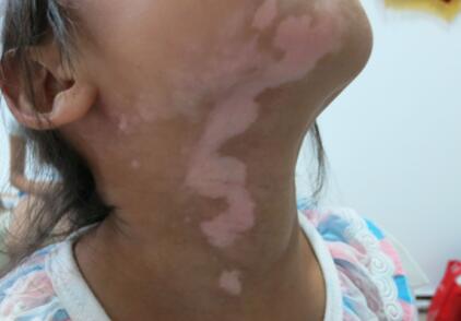 A girl: choose professional vitiligo hospital