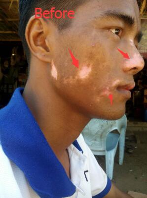 A Myanmar Vitiligo Patient Treatment experience