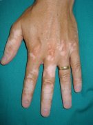 How to Prevent Vitiligo in Our Daily Life