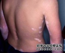 Can Vitiligo be Cured Completely