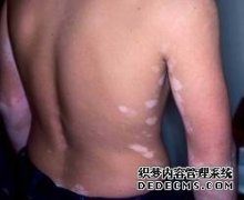 Can Vitiligo be Cured Completely