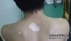 Is Vitiligo Hard to Be Cured