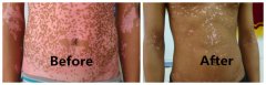 How to stop vitiligo spreading