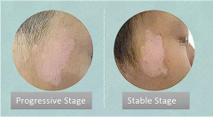 Why Should Vitiligo be Treated based on Sta