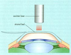 The Principles of 308 Excimer Laser Treatme