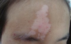 How to Identify Early Vitiligo?