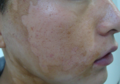 Do you know segmental vitiligo?