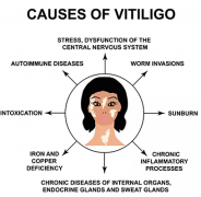 What reason causes vitiligo