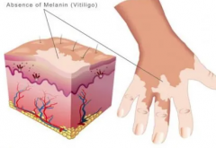 The Three Factors Which Lead To Vitiligo