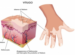 Vitiligo and Gender