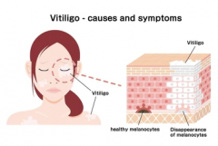 Is Vitiligo Related With Autoimmune Functio