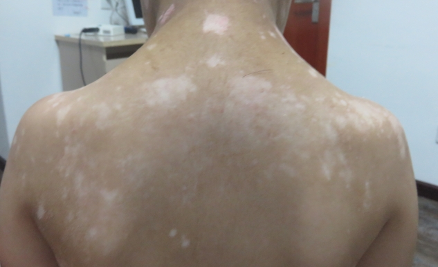 vitiligo on back